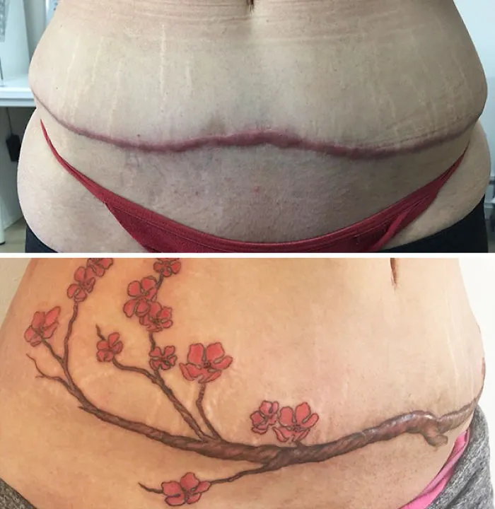 Tattoo art transforming abdominal scar into a cherry blossom branch design.