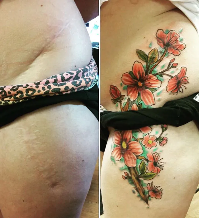 Floral tattoo transforming a scar into art on the side of a torso.