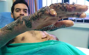 The Story Of The Treatment Of Burns Using The Skin Of Tilapia Fish