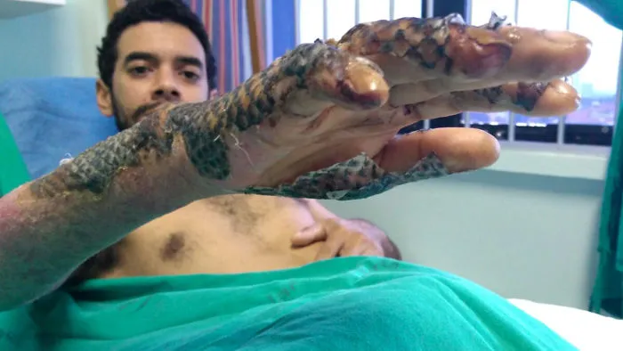 The Story Of The Treatment Of Burns Using The Skin Of Tilapia Fish