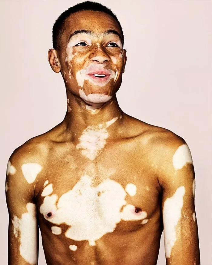 Photographer Brock Elbankcaptar Beauty In People With Vitiligo