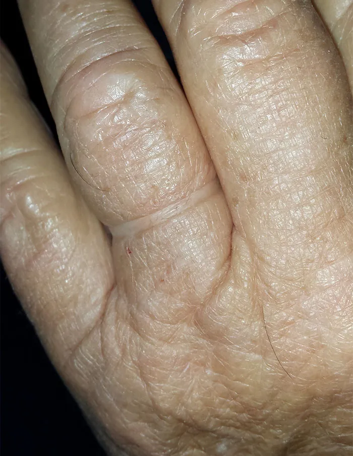 Mi abuelo tuvo que cortar su anillo de boda tras pasar 55 años sin poder quitárselo