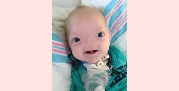‘Miracle Baby’ Born Without A Nose Dies At Age Two