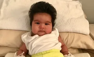 Hairy 2-Month-Old Baby Girl