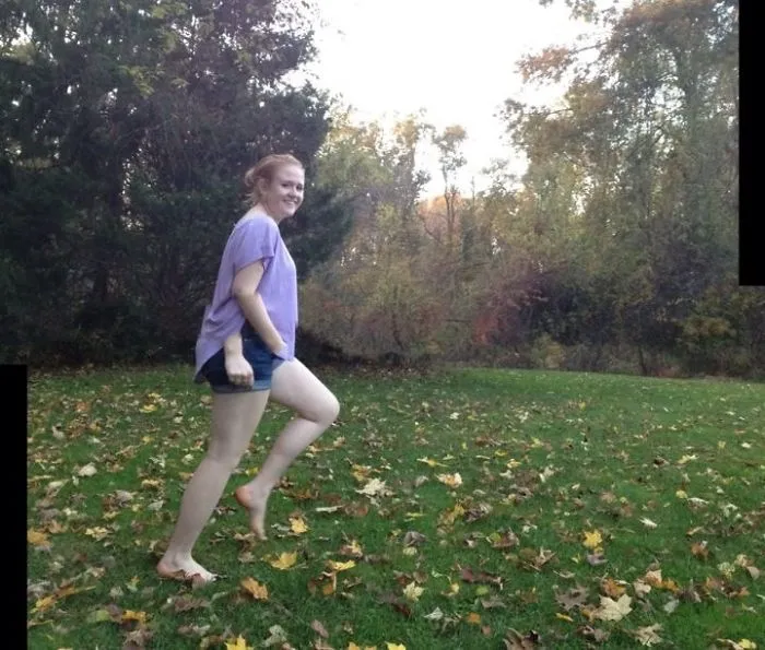Woman Sprouts New Arm Out Of Her Hip!!