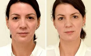 How Drinking 3 Liters Water A Day Changed My Face (That Will Inspire You To Get More Structured Face Cut)
