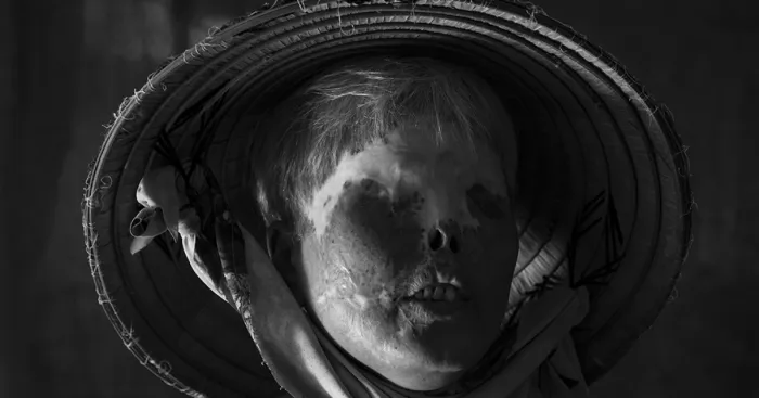 More Brutal Than Death Reality Of Acid Burn Victims Of Vietnam