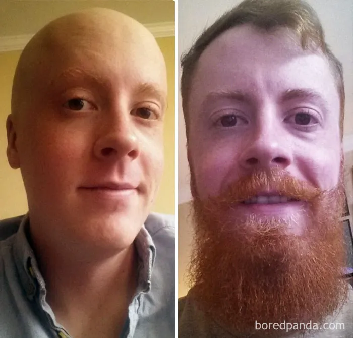 An Update On My Beard. 10 Months Cancer Free!