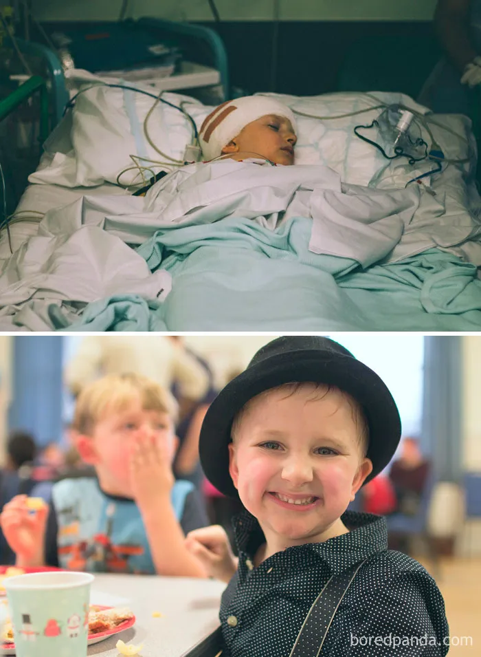 14 Rounds Of Chemo, 30 Radiations And 4 Surgeries. My Little Boy Is Cancer Free And Doing Well. Pic From His Last Surgery And Now
