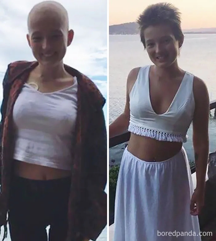 Exactly One Year Ago To The Day... Stage IV Rhabdomyosarcoma Cancer Survivor. 19 Years Old. Was Given Three Months To Live, 14 Months Later I Am Clear Of Cancer