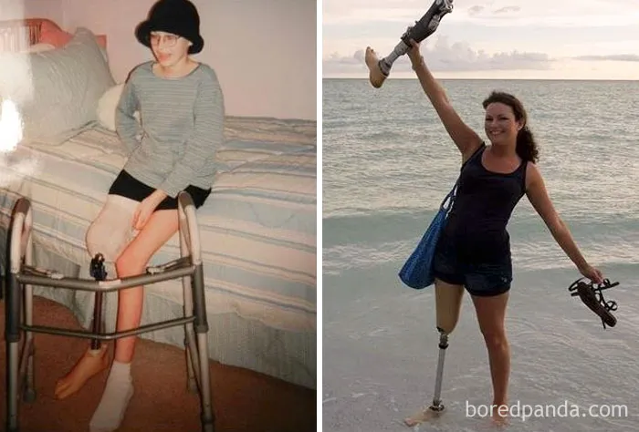 Today, I Am Officially 10 Years Cancer Free! Here Is A Before And After Photo To Show How Far I've Come. Kicking Cancer's Ass 10 Years And Counting