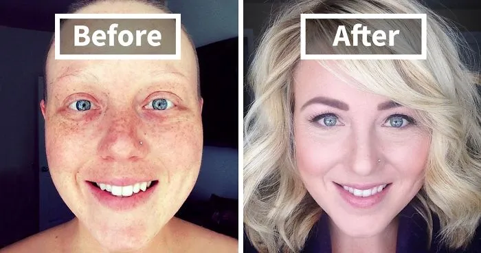 30 Incredible Before & After Pics Of People Who Beat Cancer That Will Make You Appreciate Life
