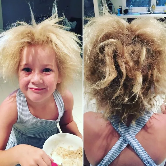 Meet The Rare Syndrome That Leaves The Girl's Hair Totally Wild, Literally Unthinkable