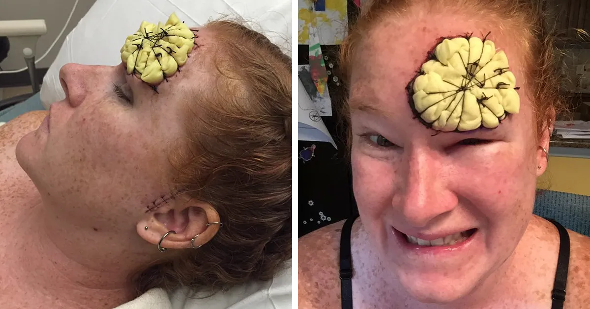 If This Mom's Before & After Photos Don't Scare You About Skin Cancer, Nothing Will
