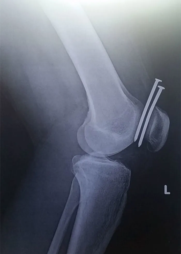 This Guy Had Two Nails From A Nail Gun Hit His Leg, And They Both Missed His Femur And His Kneecap