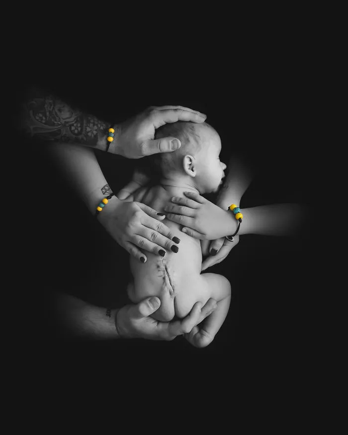 A Powerful Image For Spina Bifida Awareness