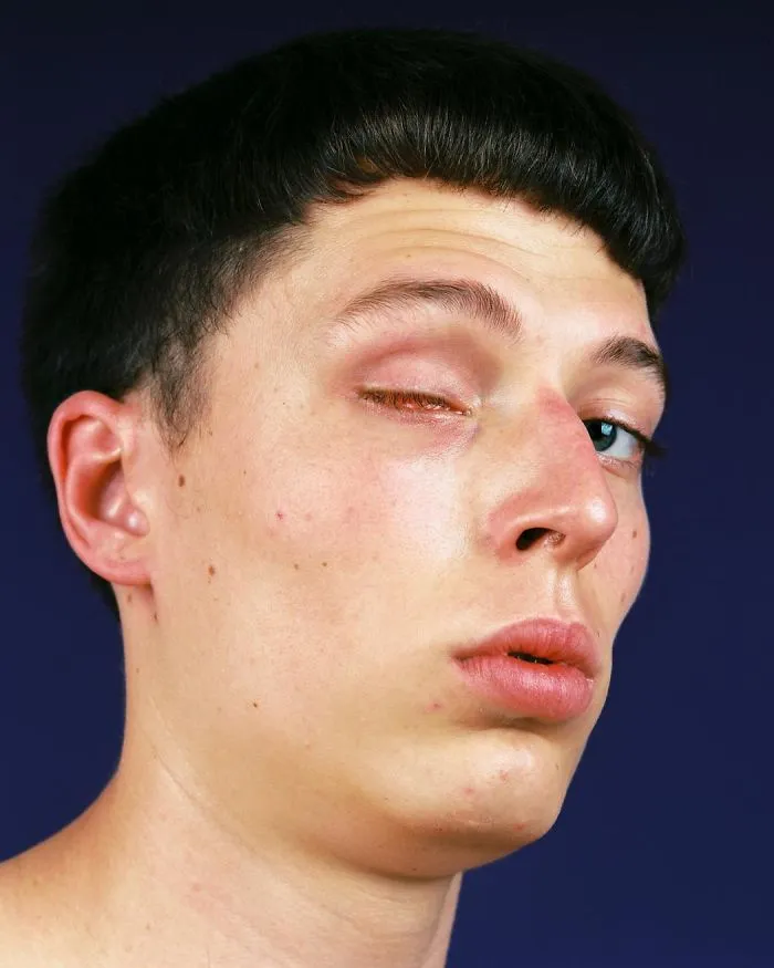 Jordi Had His Eye Removed As A Child Due To A Tumour Growing Behind Him