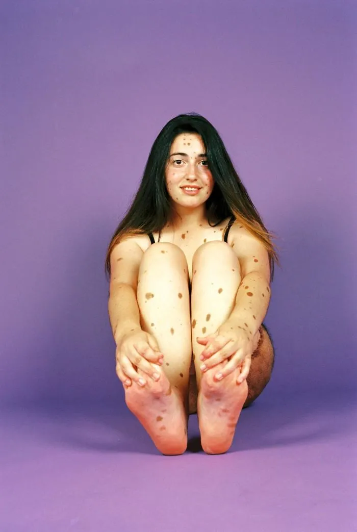 Alba Parejo Who Was Born With More Than 500 Moles And Dark Hairy Skin Over