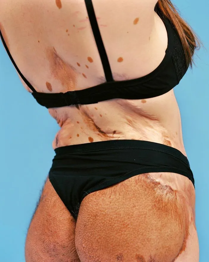 "My Ex-Boyfriend Told Me Not To Show My Back To Anyone Because Nobody Wants To Have A Deformed Girlfriend" Alba Shared