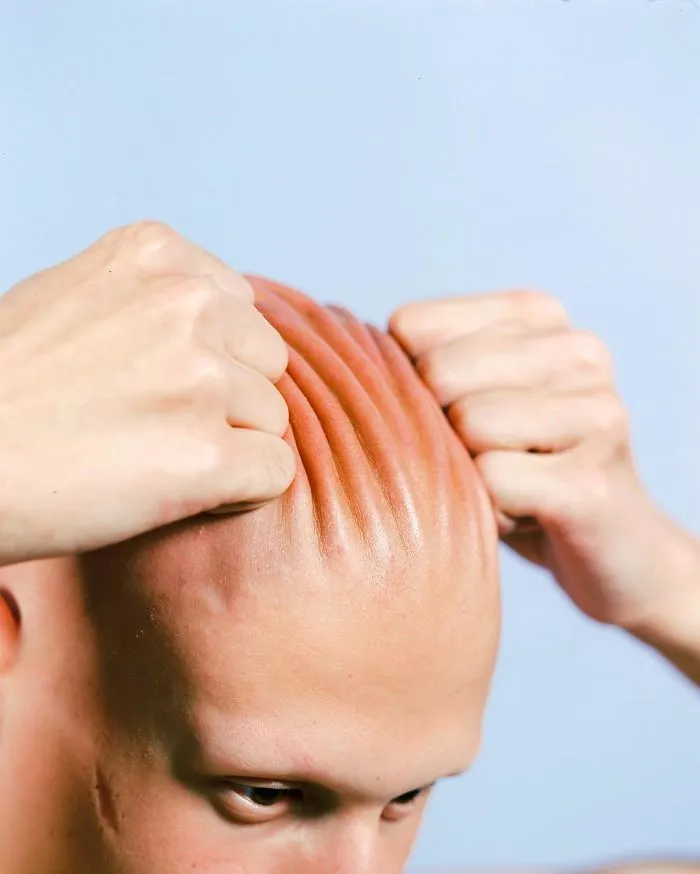 Guille Suffers From Alopecia