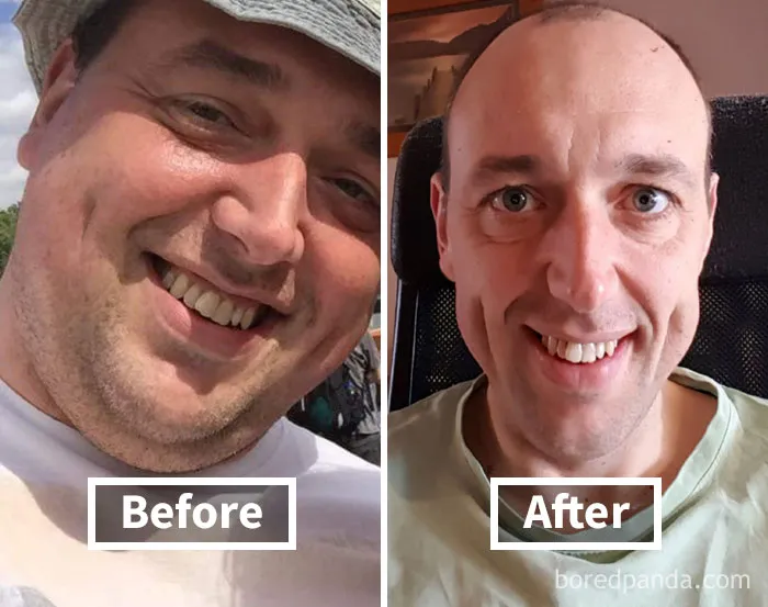 Before and after photos showing face fat loss, highlighting significant weight loss transformation.