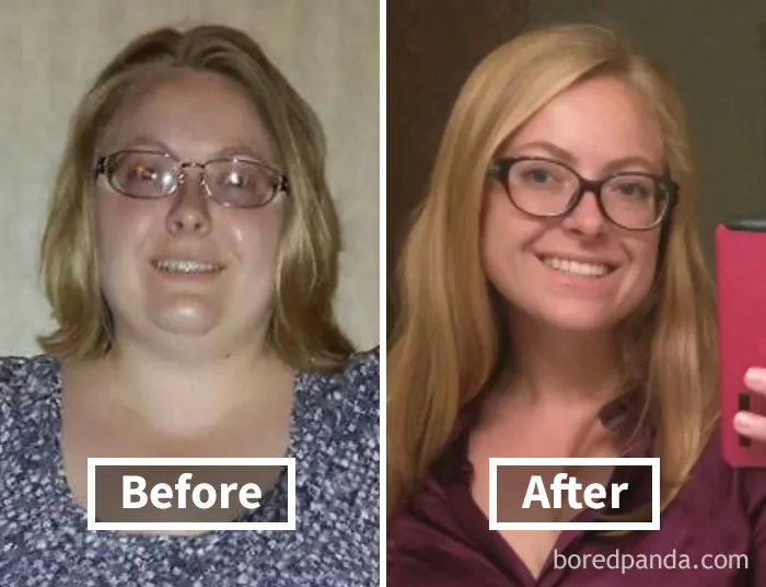 Before and after photos showing face fat loss in a woman wearing glasses.