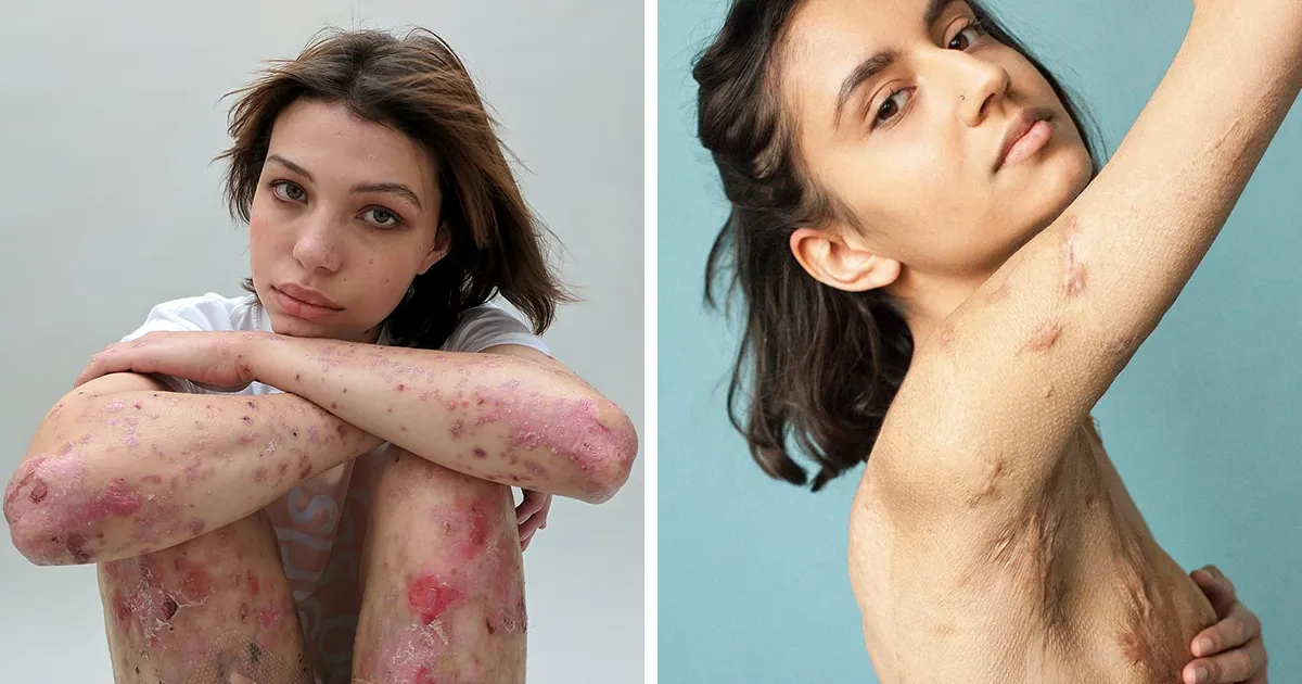 Algunas personas revelan sus cicatrices y de dónde vienen en un potente proyecto fotográfico