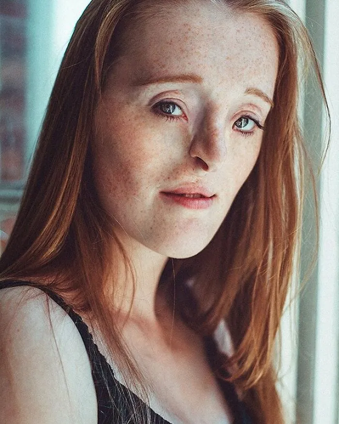 Esta chica de 26 años nacida con un raro defecto facial rompe los estándares de belleza con su carrera de modelo