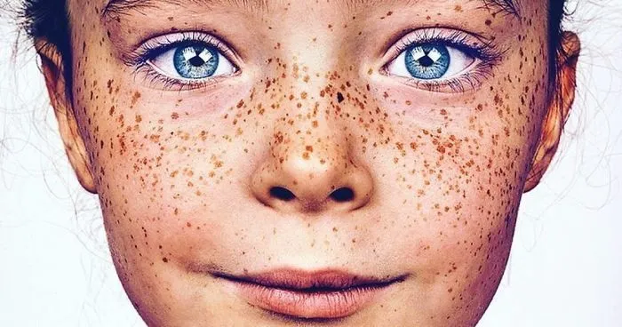 Photographer Takes Portraits Of Freckled People To Celebrate Their Unique Beauty