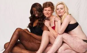 I Started This Campaign To Encourage People Love Themselves With All Their Differences