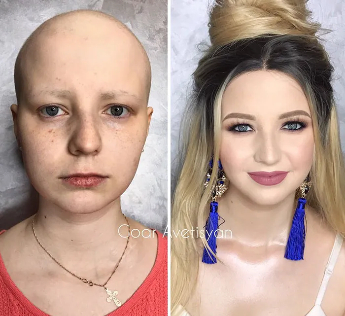 Tras su transformación, Julia fue al hospital a recibir su tratamiento de quimioterapia. Ella y su marido estaban asombrados con los resultados