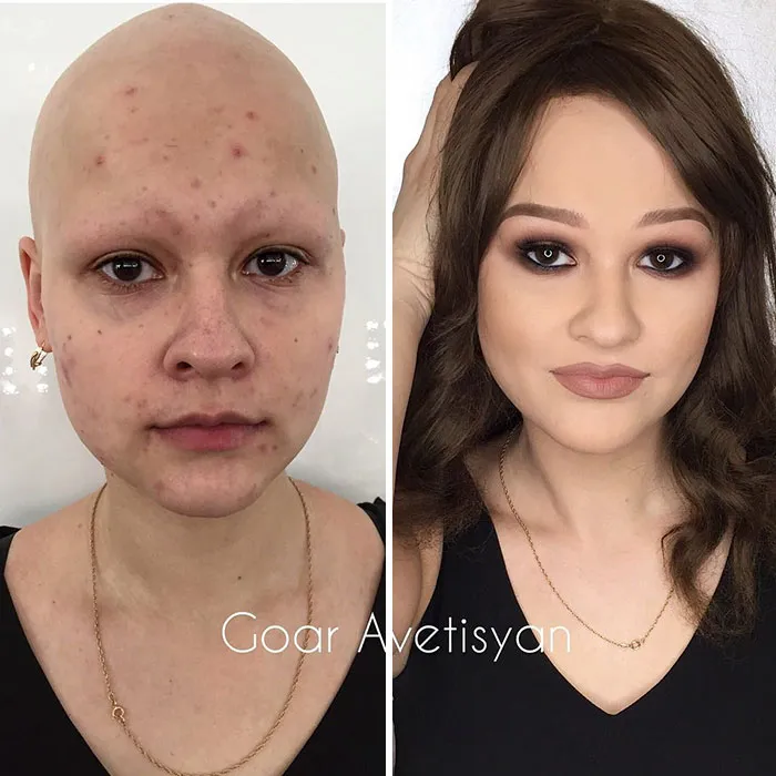 Ann tiene alopecia, y su transformación le sirvió para seguir luchando contra ella