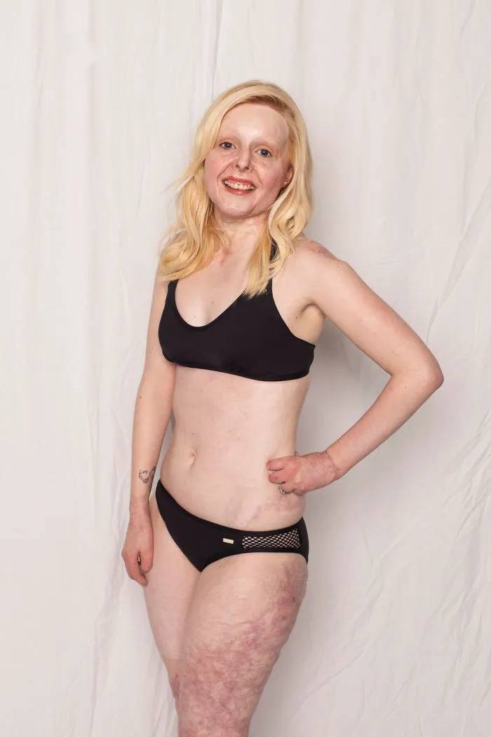 I Started This Campaign To Encourage People Love Themselves With All Their Differences