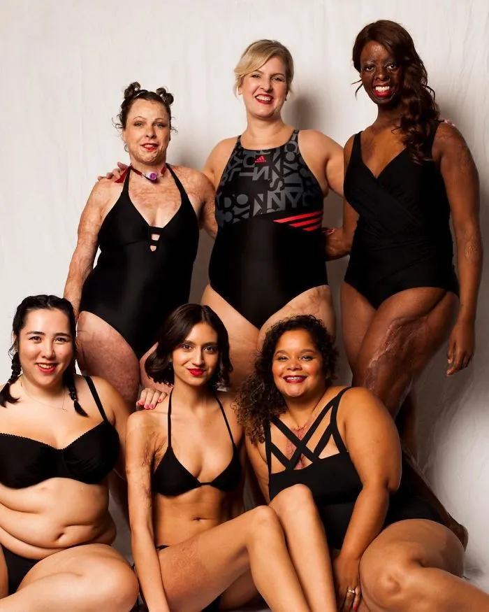 I Started This Campaign To Encourage People Love Themselves With All Their Differences