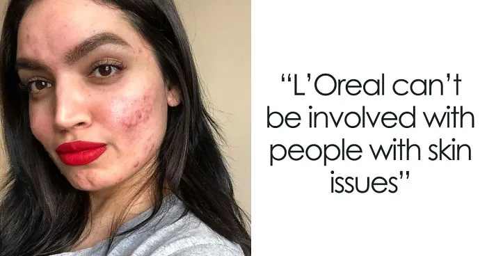 Woman Gets Dropped From L’Oréal's Campaign Because Of Her Acne, She Responds With A Powerfull Message