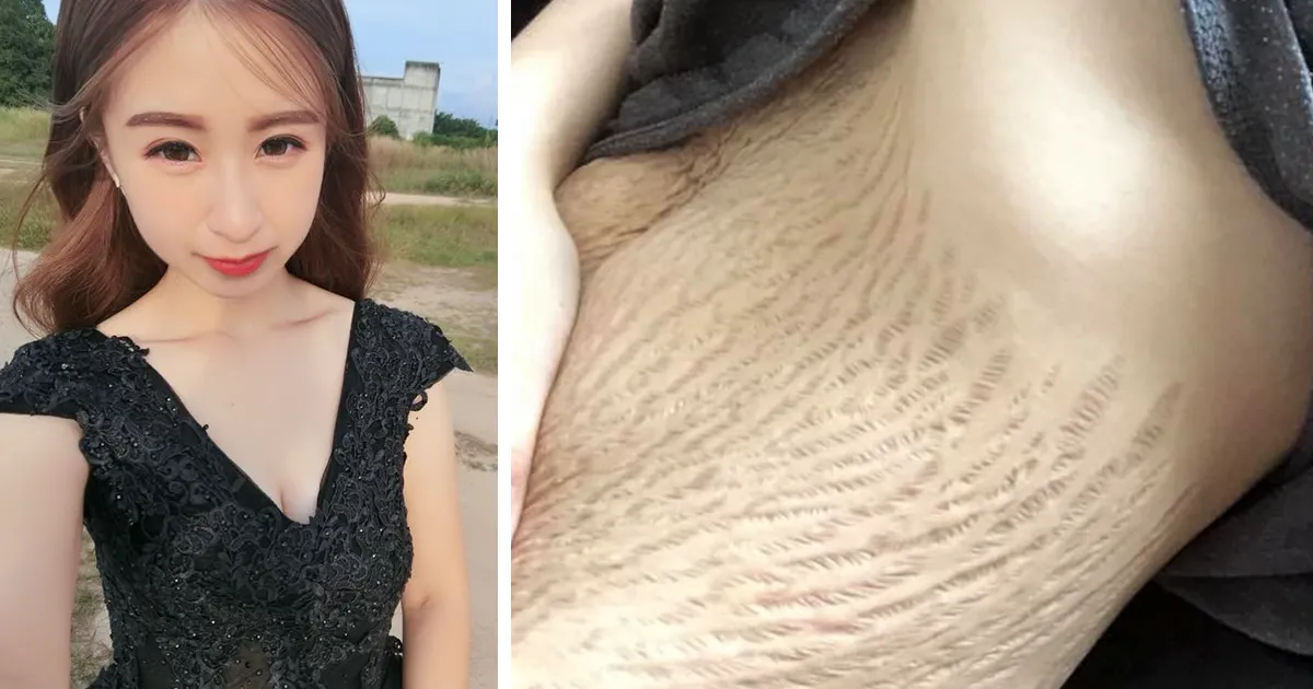 Los trolls le dijeron a esta madre de 23 años que sus "asquerosas" estrías dan náuseas, pero ella supo cómo responder