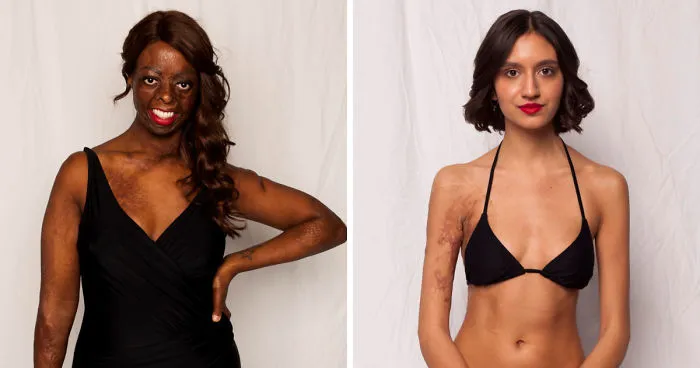 I Started This Campaign To Encourage People Love Themselves With All Their Differences