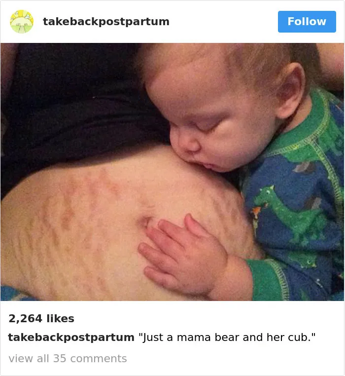 90 Brutally Honest Photos Of Post-Baby Bodies, That Women Are Sharing To Reveal The Truth No One Talks About