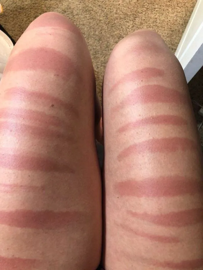 Las piernas de mi prima tras un día al sol con vaqueros rajados