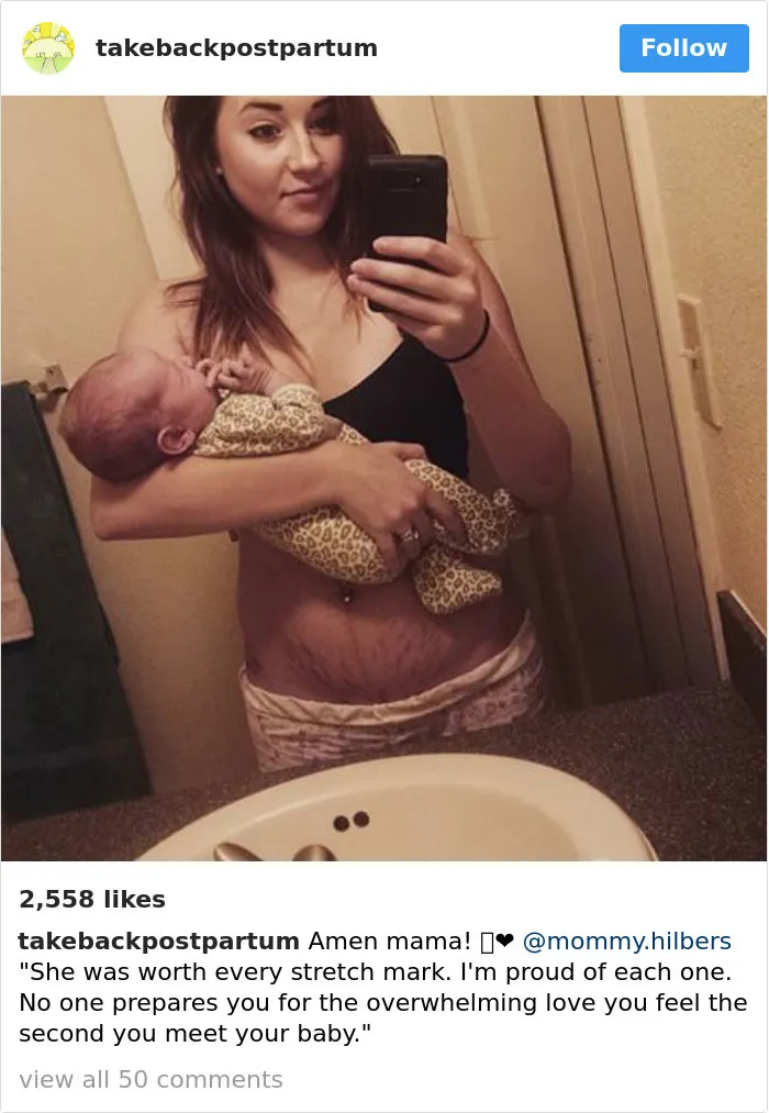 90 Brutally Honest Photos Of Post-Baby Bodies, That Women Are Sharing To Reveal The Truth No One Talks About