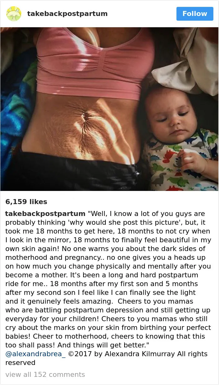 90 Brutally Honest Photos Of Post-Baby Bodies, That Women Are Sharing To Reveal The Truth No One Talks About