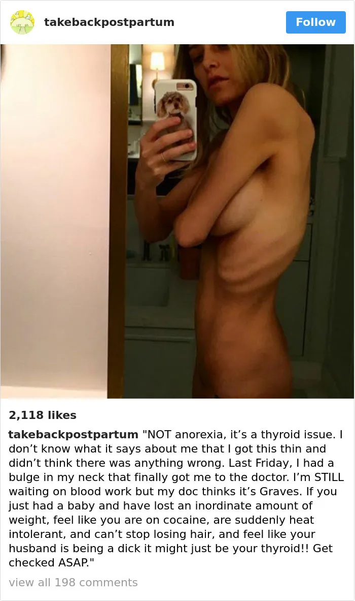 90 Brutally Honest Photos Of Post-Baby Bodies, That Women Are Sharing To Reveal The Truth No One Talks About