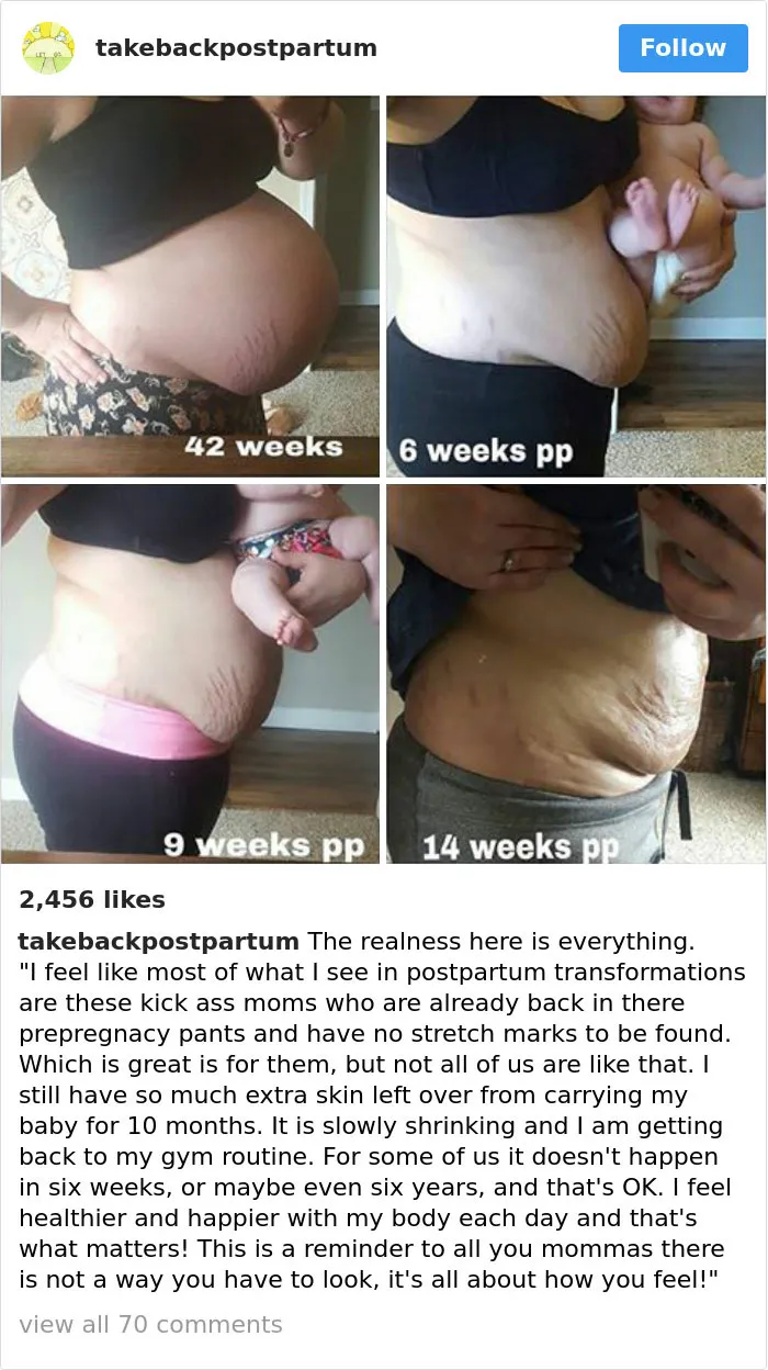 90 Brutally Honest Photos Of Post-Baby Bodies, That Women Are Sharing To Reveal The Truth No One Talks About