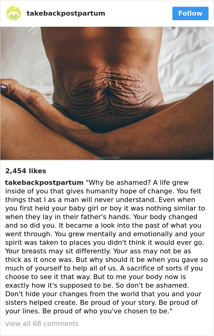 90 Brutally Honest Photos Of Post-Baby Bodies, That Women Are Sharing To Reveal The Truth No One Talks About