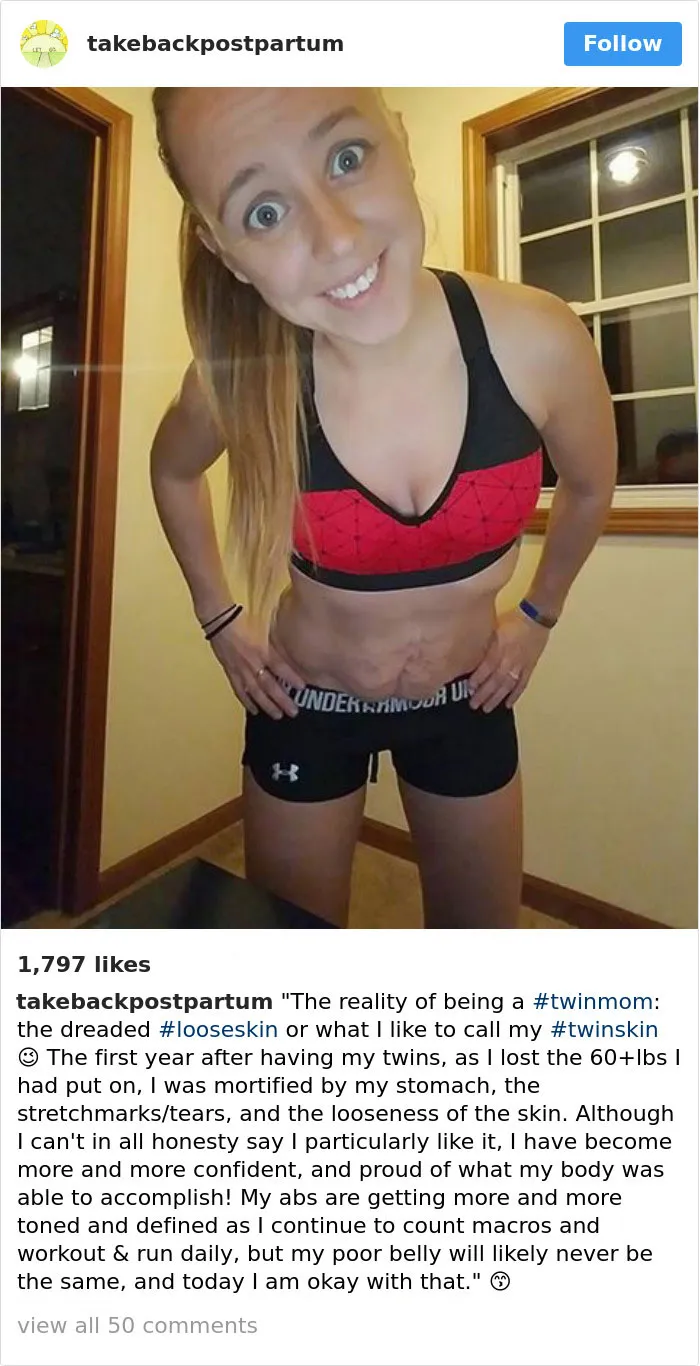 90 Brutally Honest Photos Of Post-Baby Bodies, That Women Are Sharing To Reveal The Truth No One Talks About