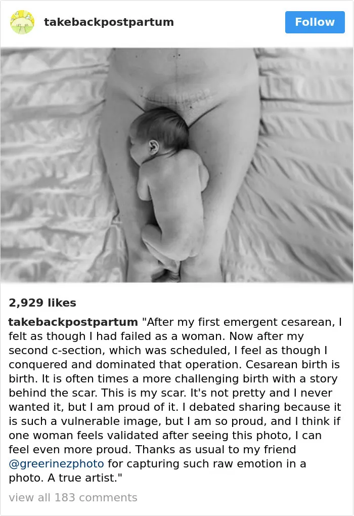 90 Brutally Honest Photos Of Post-Baby Bodies, That Women Are Sharing To Reveal The Truth No One Talks About