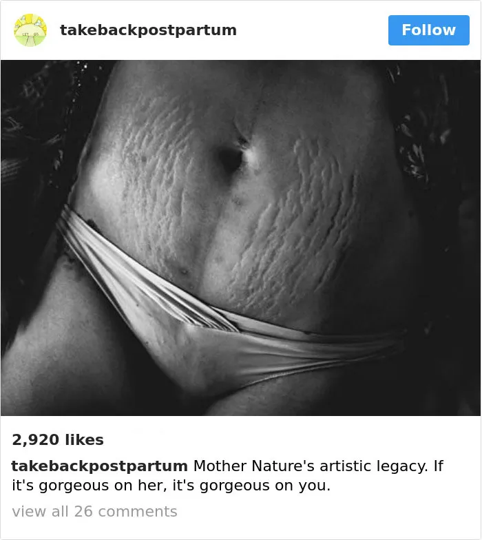 90 Brutally Honest Photos Of Post-Baby Bodies, That Women Are Sharing To Reveal The Truth No One Talks About