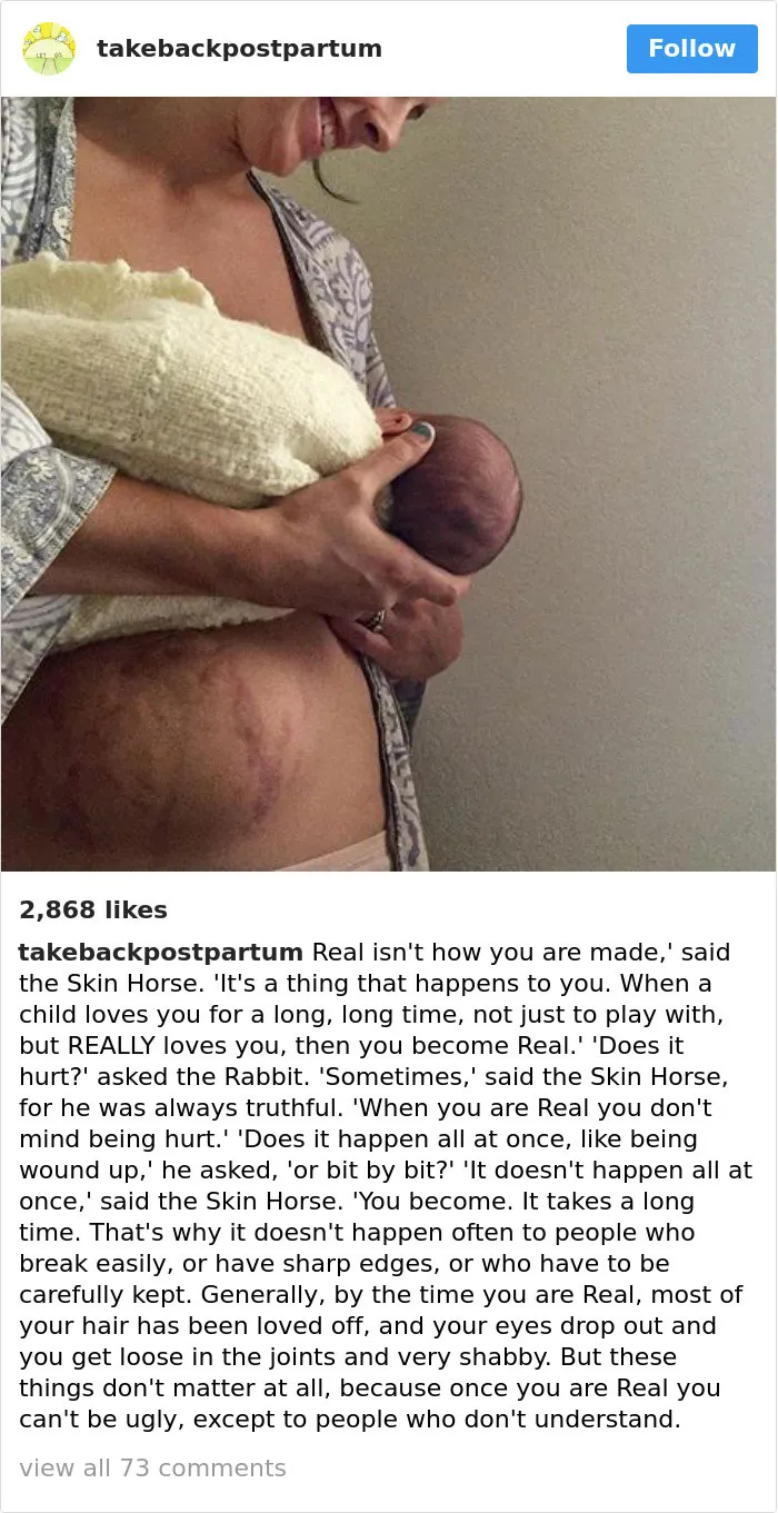 90 Brutally Honest Photos Of Post-Baby Bodies, That Women Are Sharing To Reveal The Truth No One Talks About