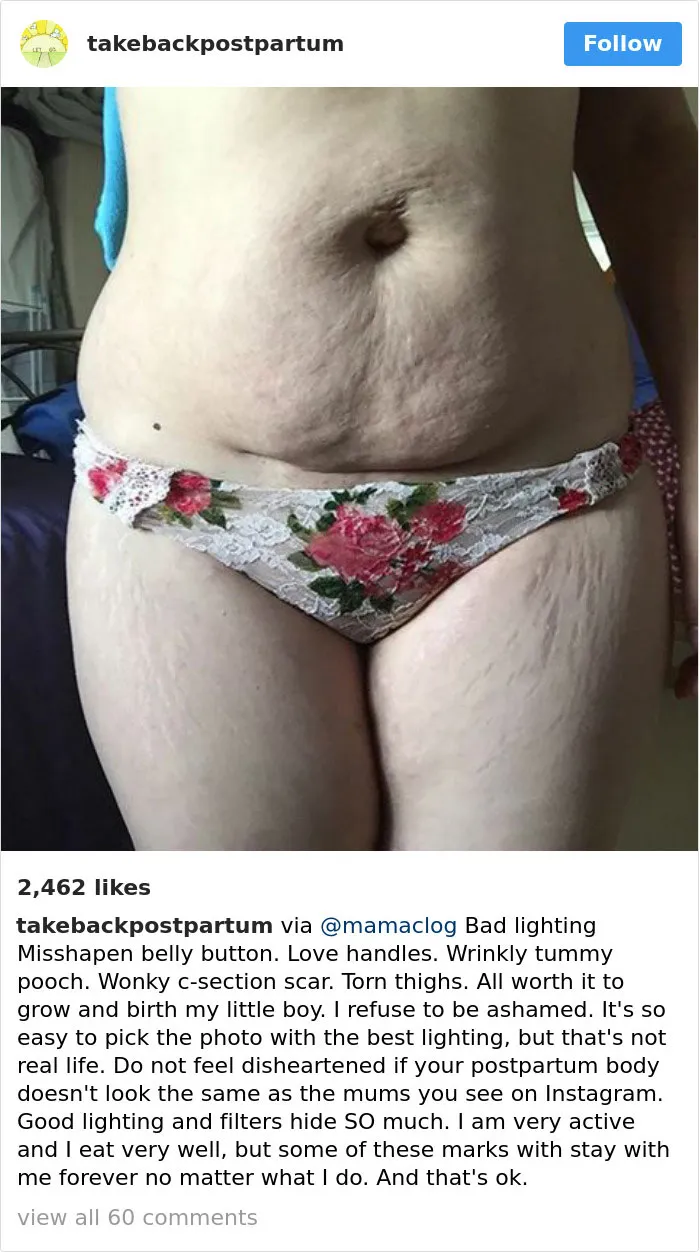90 Brutally Honest Photos Of Post-Baby Bodies, That Women Are Sharing To Reveal The Truth No One Talks About