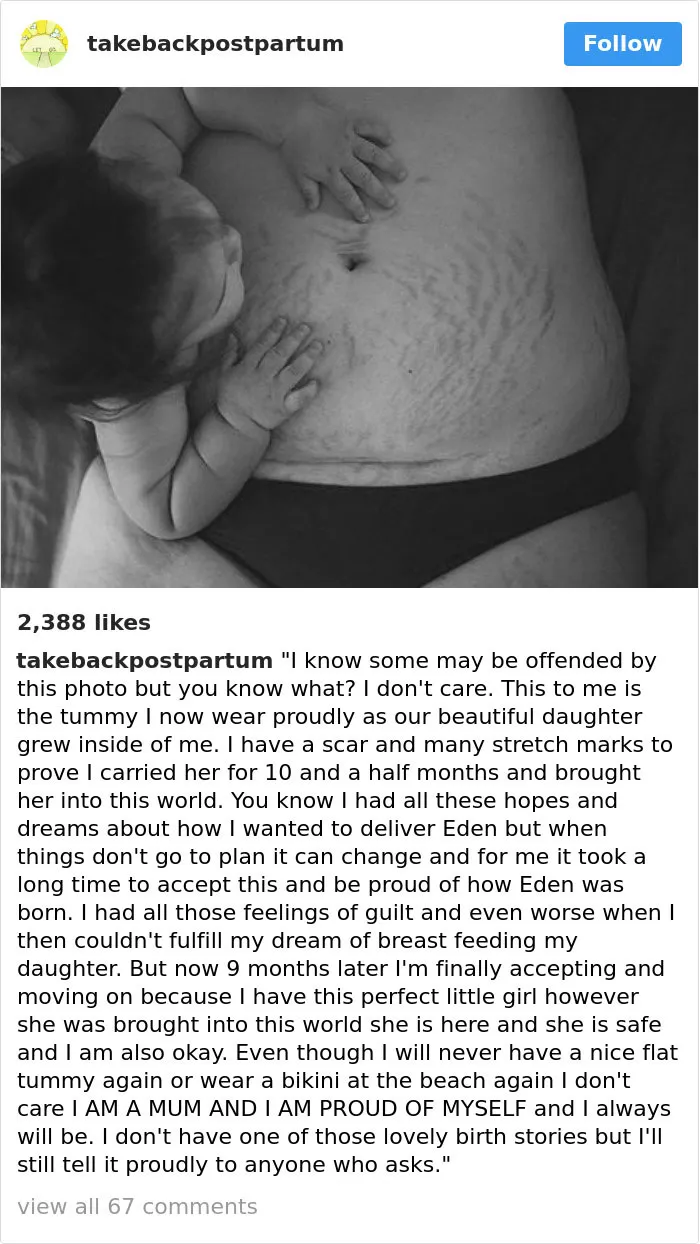 90 Brutally Honest Photos Of Post-Baby Bodies, That Women Are Sharing To Reveal The Truth No One Talks About